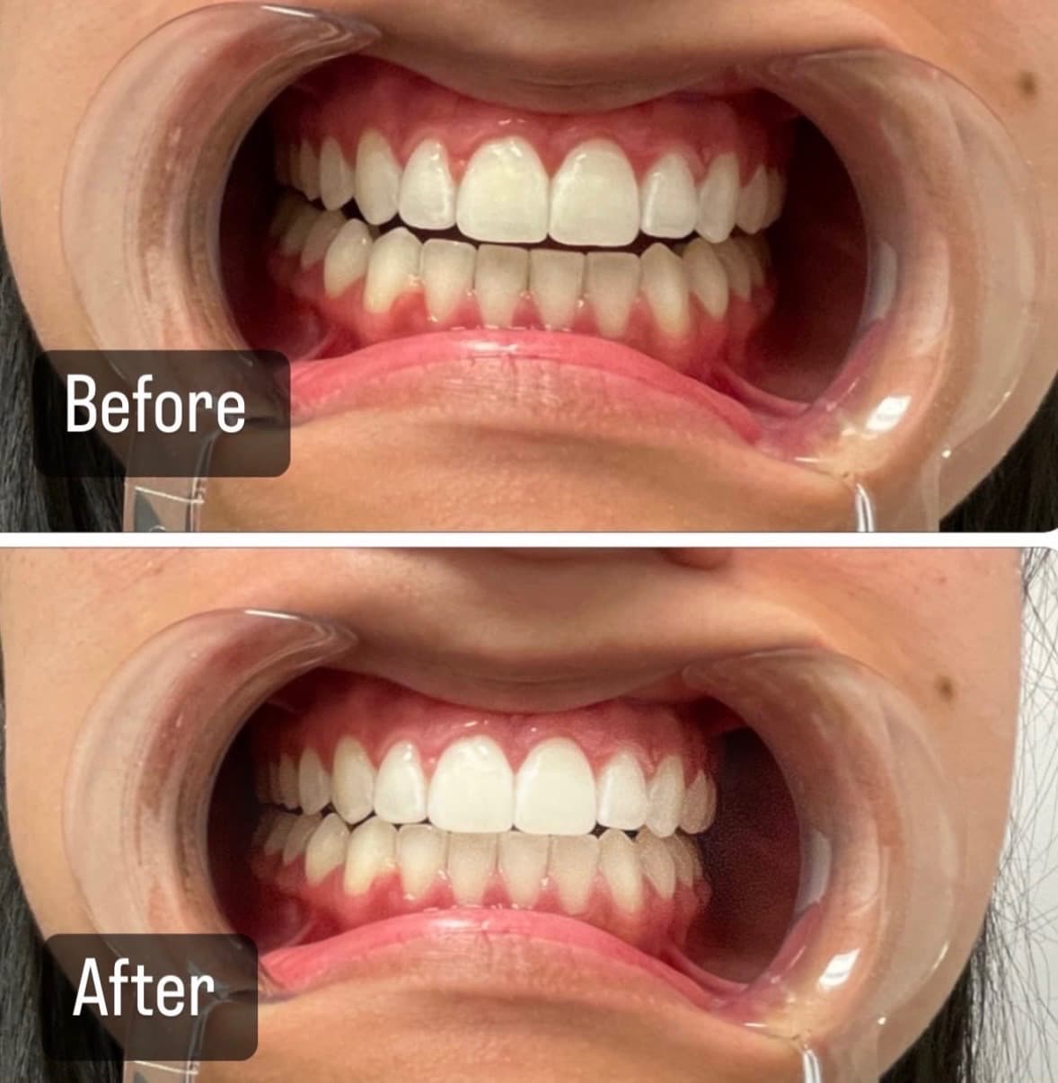 Teeth Whitening