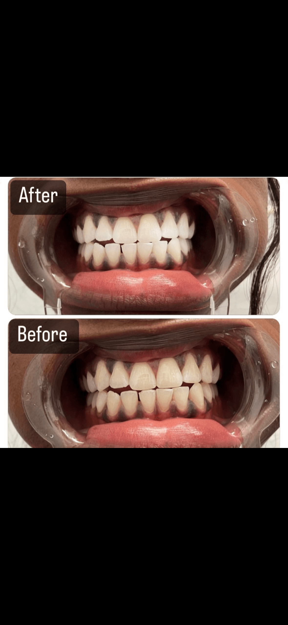 Teeth Whitening