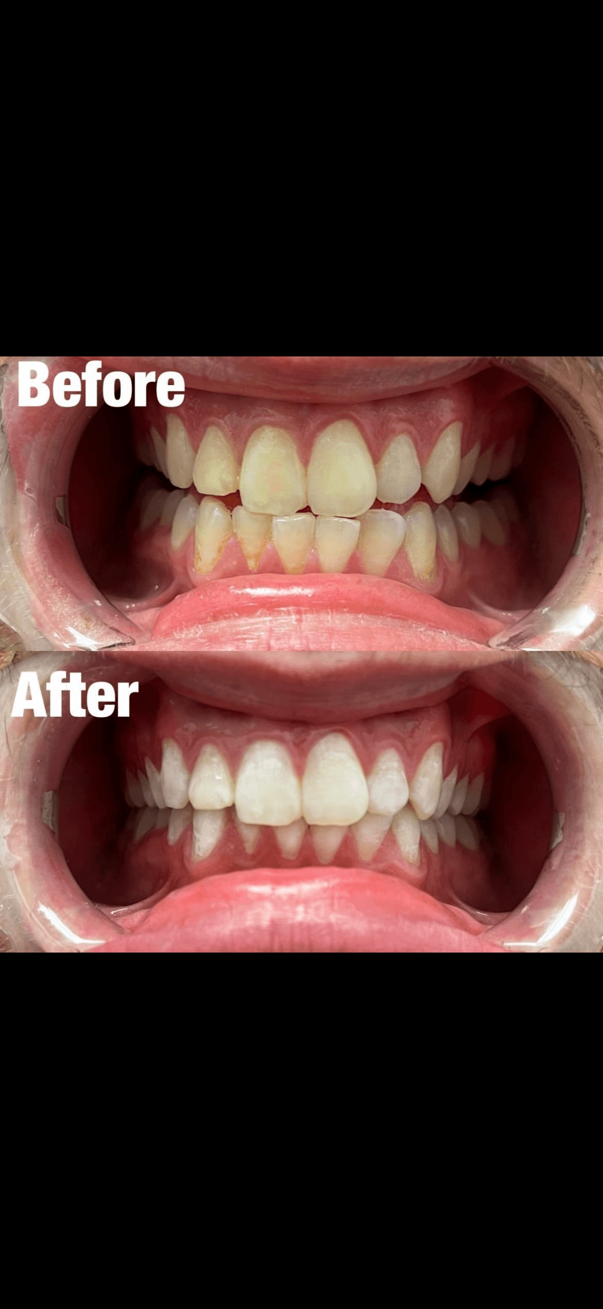 Teeth Whitening
