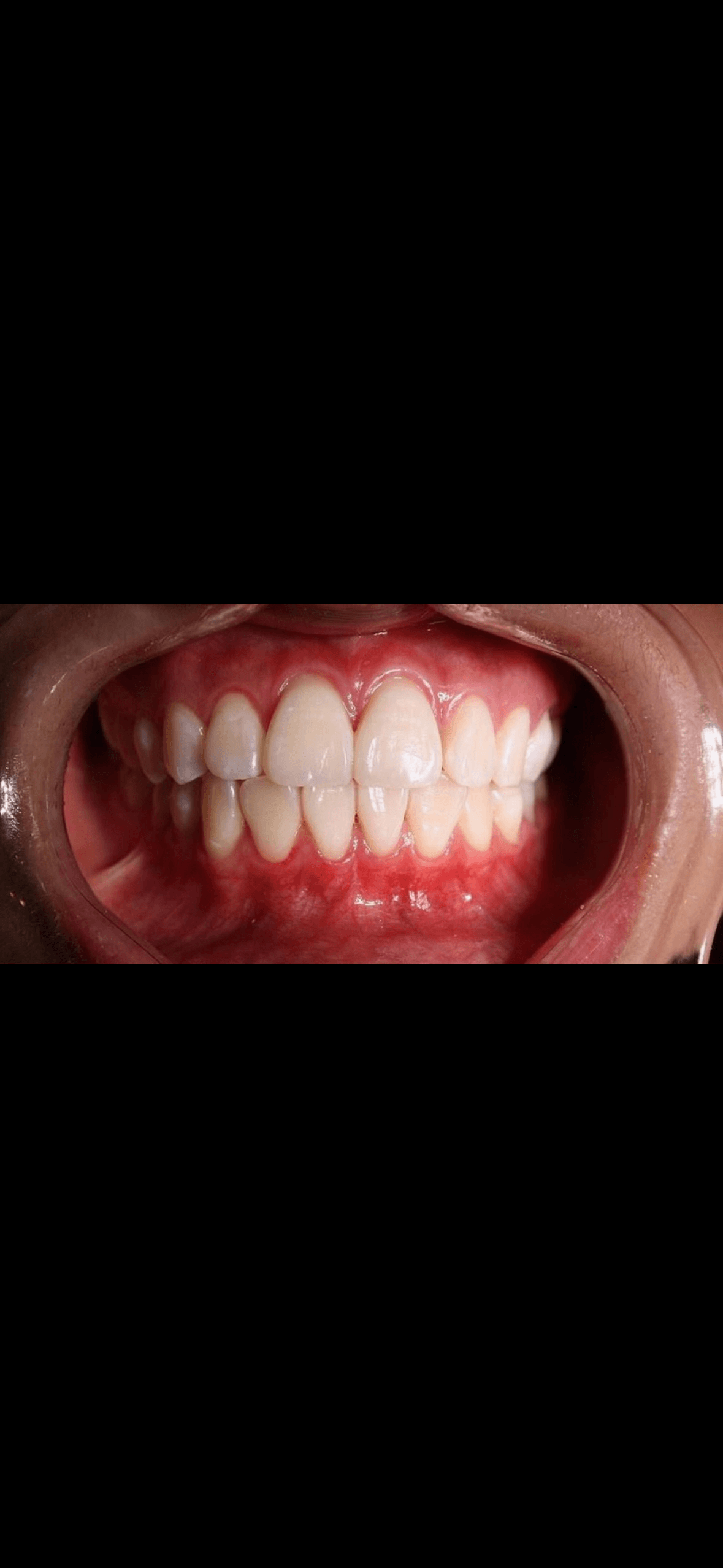 Teeth Whitening