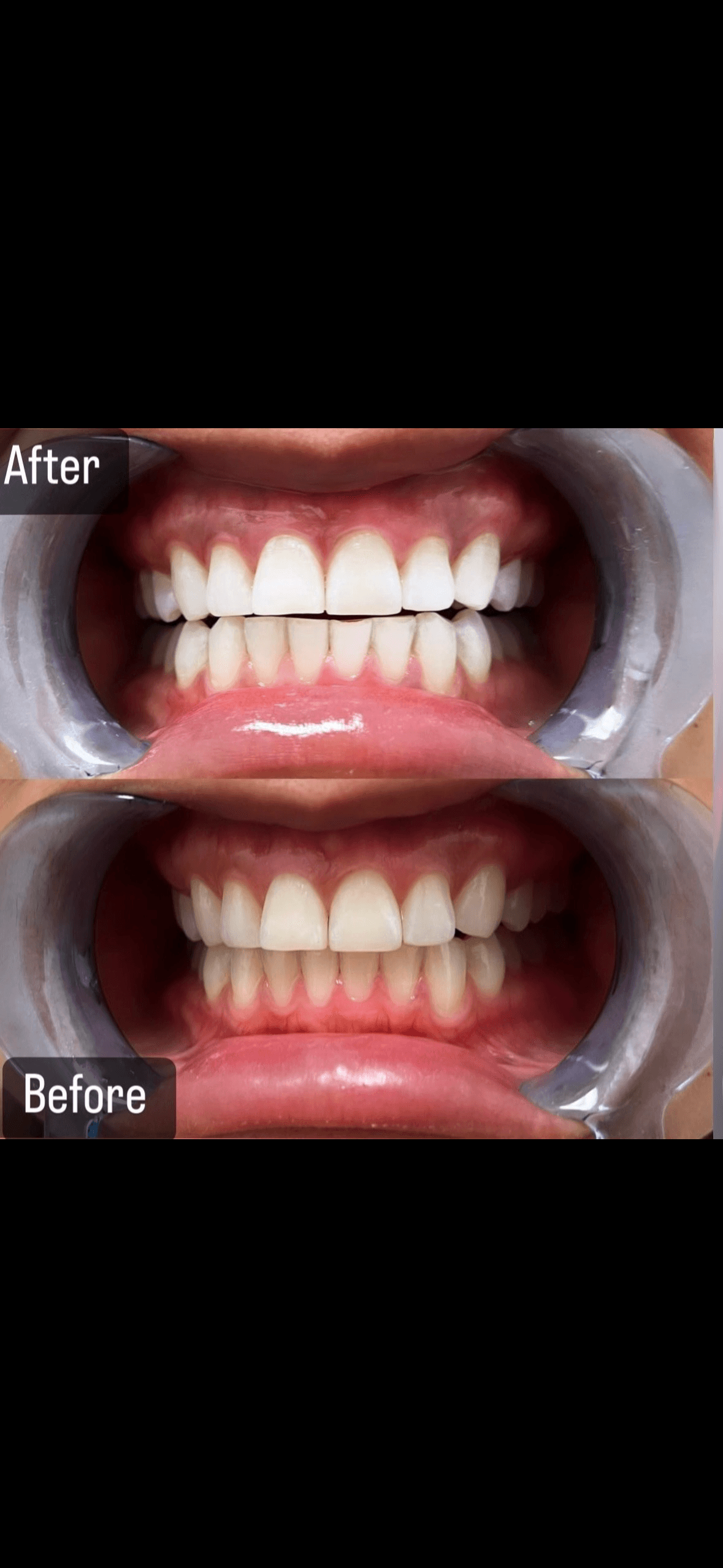 Teeth Whitening