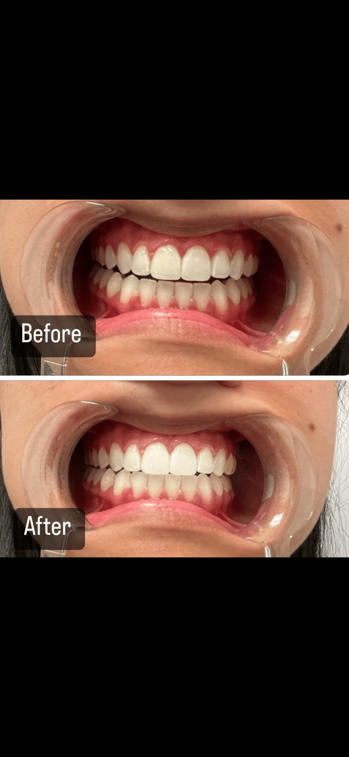 Teeth Whitening