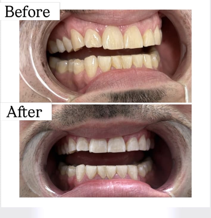 Teeth Whitening